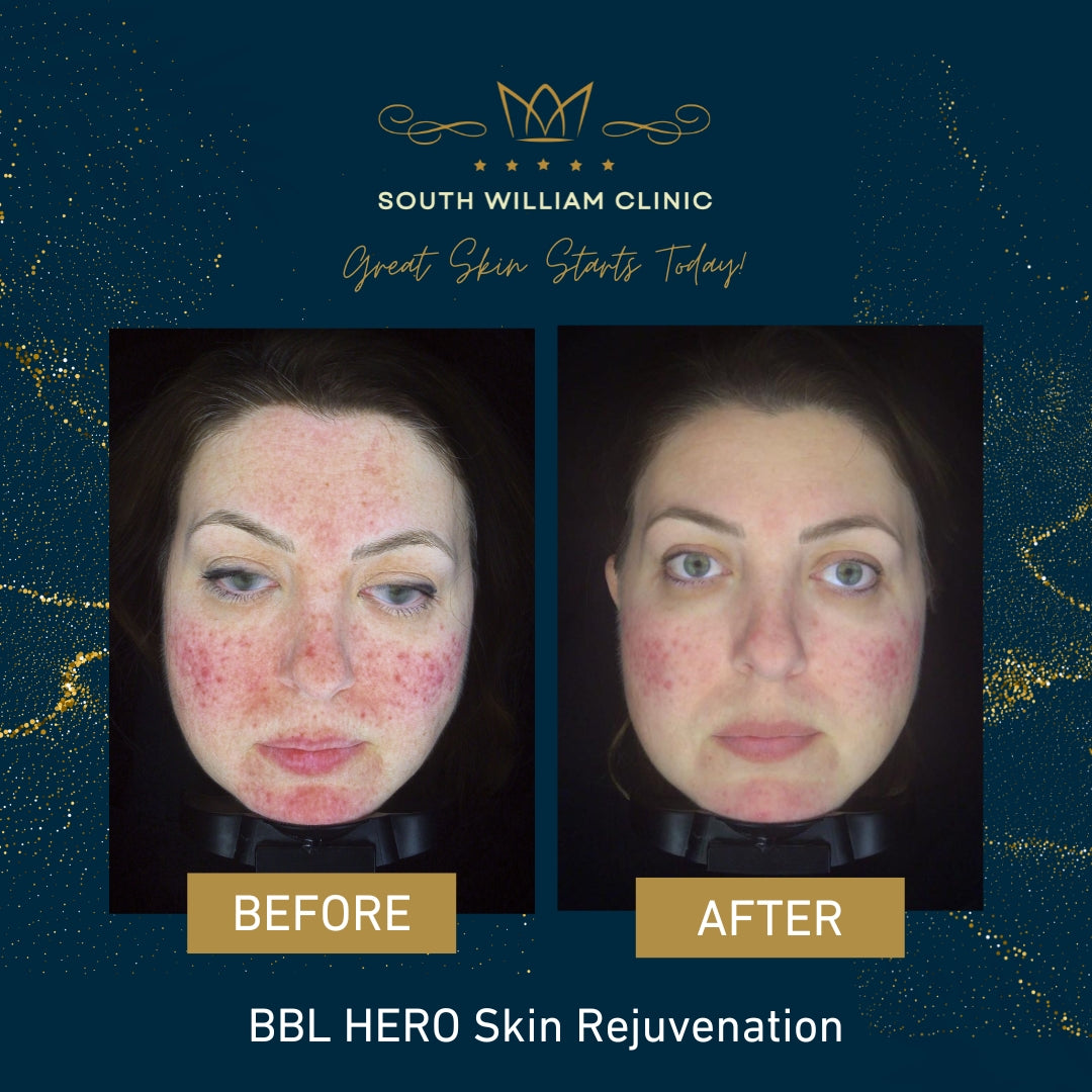 BBL HERO Photofacial Skin Rejuvenation for Face Course of 3 (save €501)