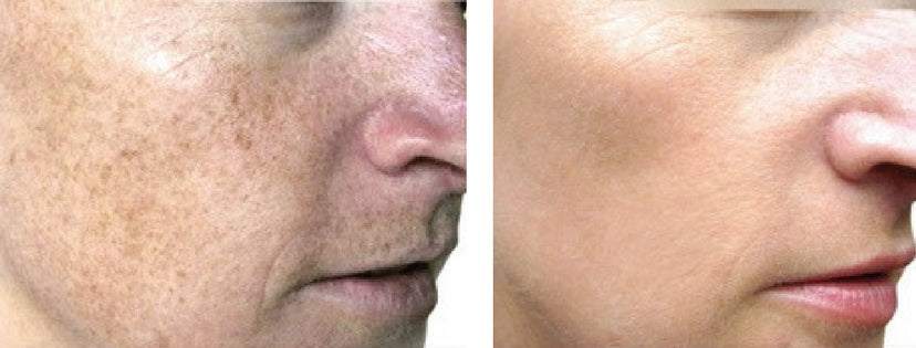 BBL HERO Photofacial Skin Rejuvenation for Face, Neck & Décolleté Course of 4 (save €701)