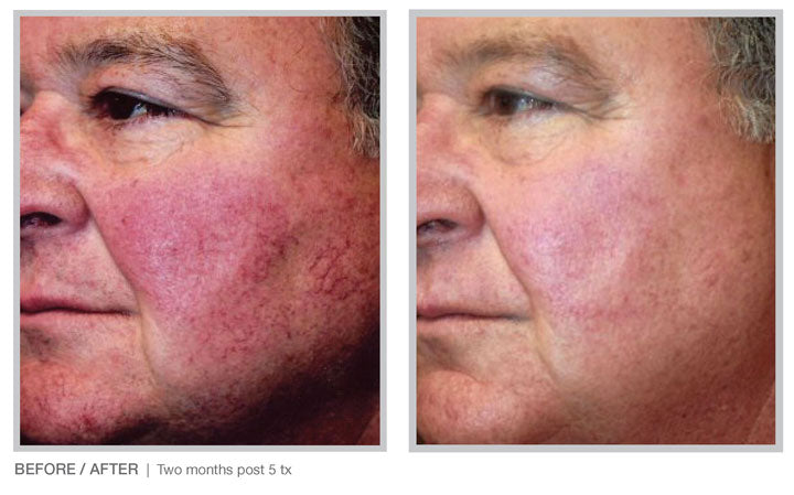 BBL HERO Photofacial Skin Rejuvenation for Face, Neck & Décolleté Course of 4 (save €701)