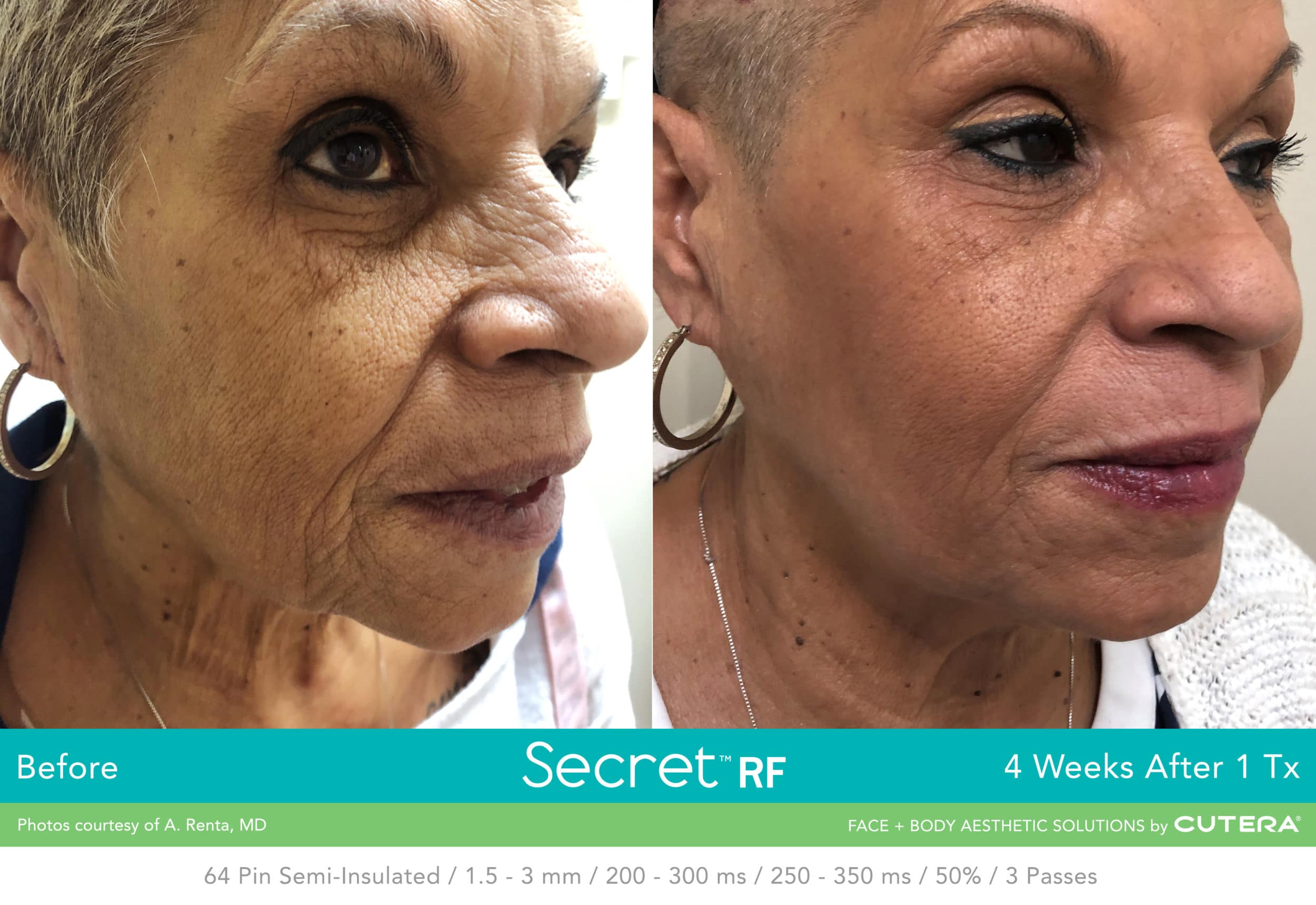Secret RF +Microneedling for Full Face & Neck course of 2 (save €501)