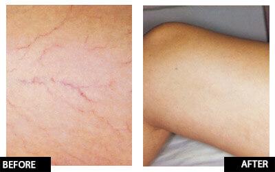 Laser thread vein reduction for large area or legs course of 4 (save €601)