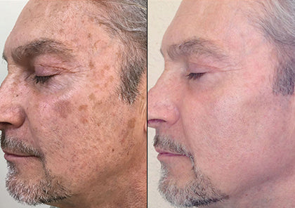 HALO Laser Skin Resurfacing Consultation with Doctor