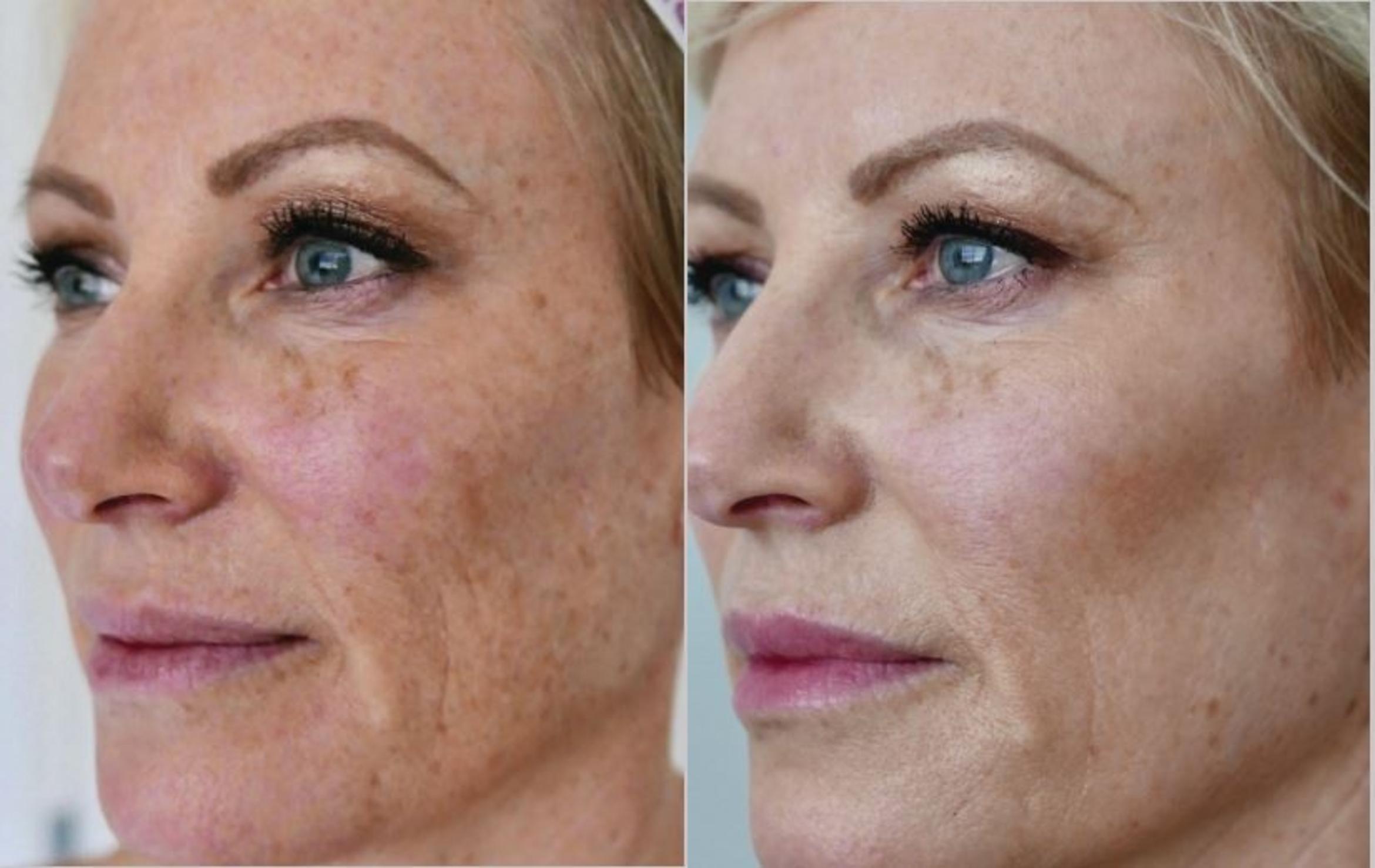 HALO Laser Skin Resurfacing for full face or neck