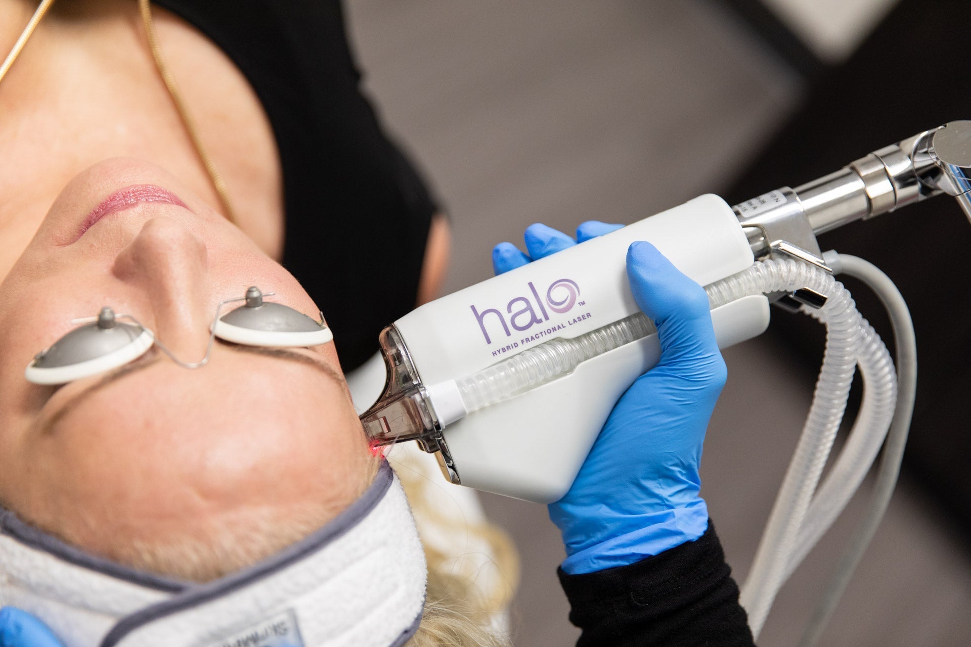 HALO Laser Skin Resurfacing for full face or neck