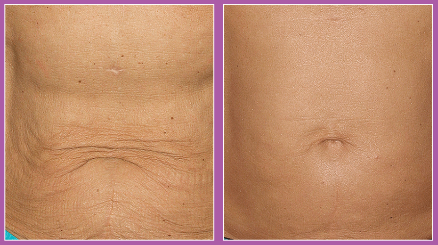 Thermage FLX full face or neck skin tightening