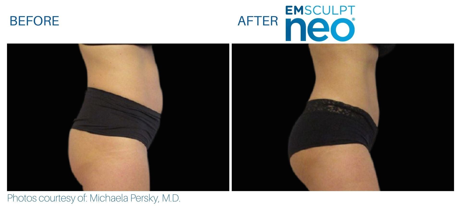 EmSculpt NEO Muscle Building & Fat Burning course of 6 or 8 (as low as €350 per session)