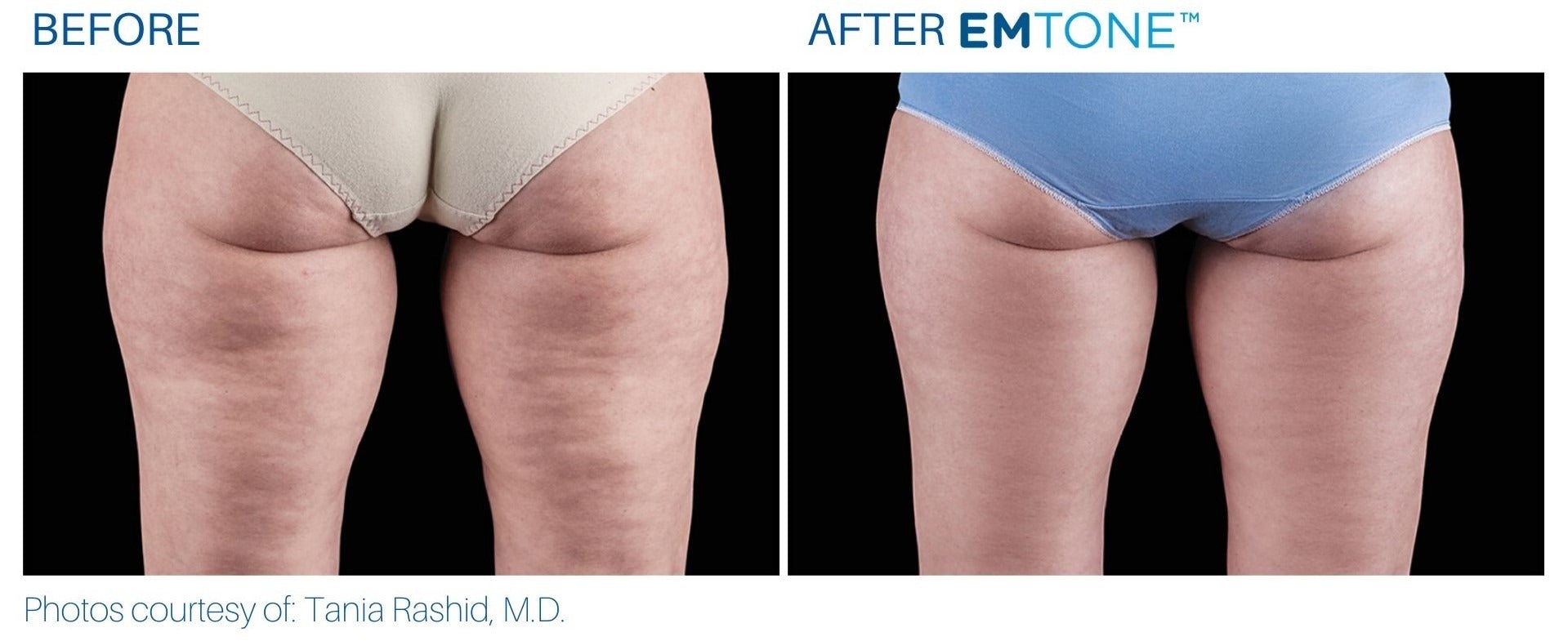 EmTone Skin Tightening & Cellulite Treatment Course of 6 for one or two areas (as low as €225 per session)