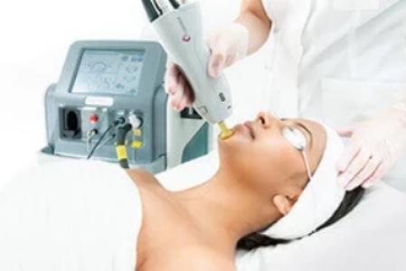 Laser thread vein removal for spot treatment on face