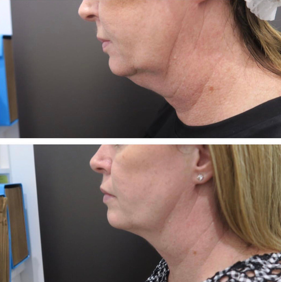 SculpSure Chin Fat Reduction two treatments