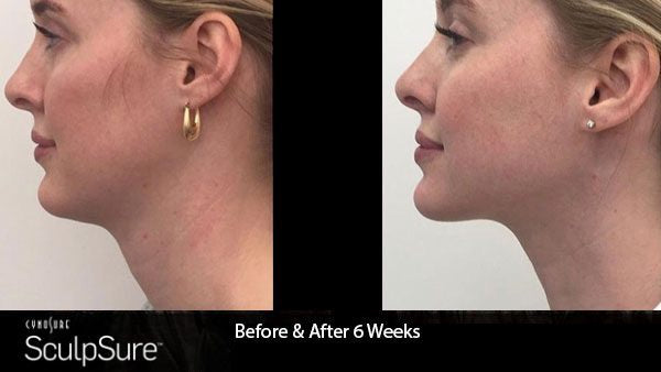 SculpSure Chin Fat Reduction Two Treatments+FREE Sublime RF (save €401)