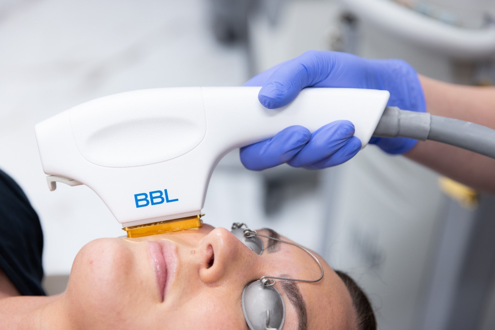 BBL HERO Skin Rejuvenation Single Treatment for Body Area