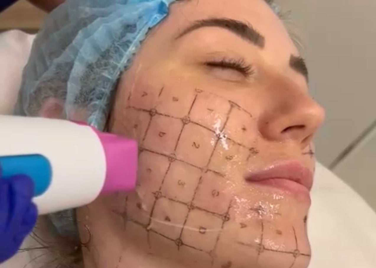 Thermage FLX full face and neck skin tightening (save €500)