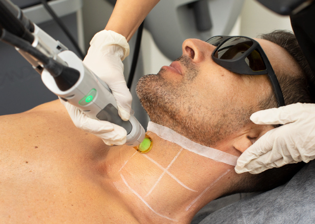 Laser Hair Removal Men's Facial Hair Package (as low as €59.90 per session)