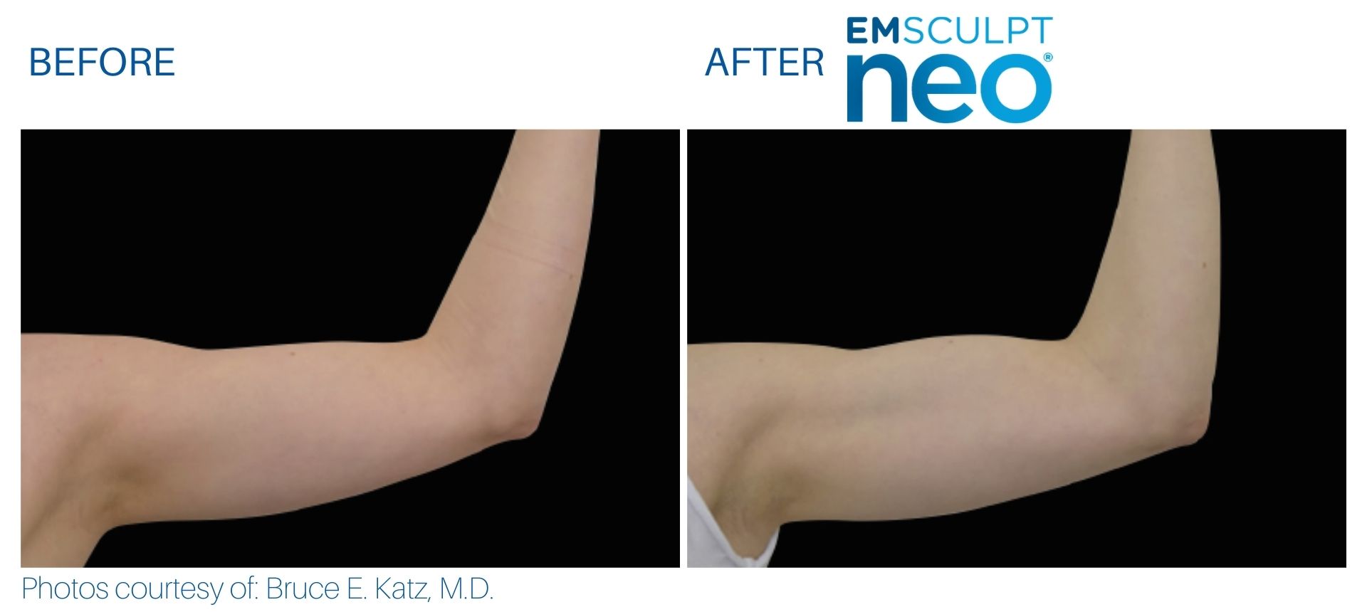 EmSculpt NEO for Muscle Building & Fat Burning Single Session One Area