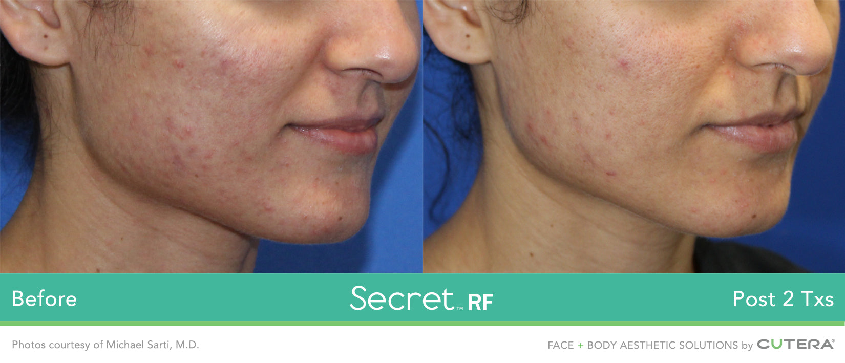 Secret RF Refine: RF+Micro-needling Full Face & Neck course of 3 (save 20%)