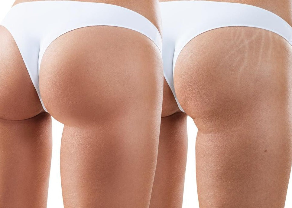 Secret PRO Refine: RF +Microneedling for Stretch Marks or Body course of 3 (save 20%)