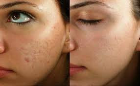 Sublative Skin Rejuvenation Treatment