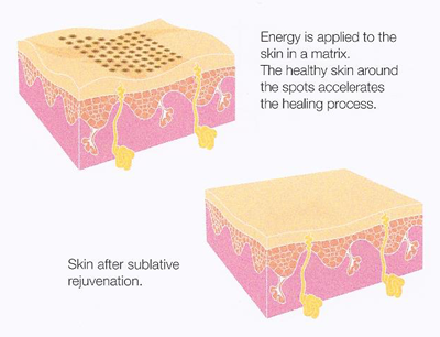 Sublative Skin Rejuvenation Treatment