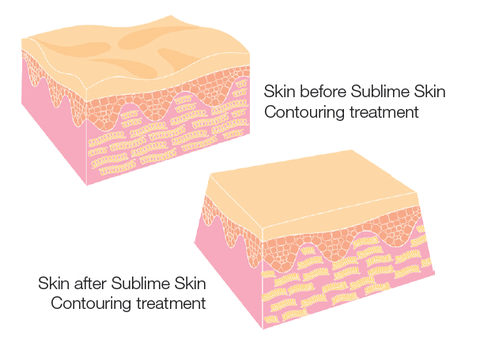 Sublative Skin Resurfacing course of 3