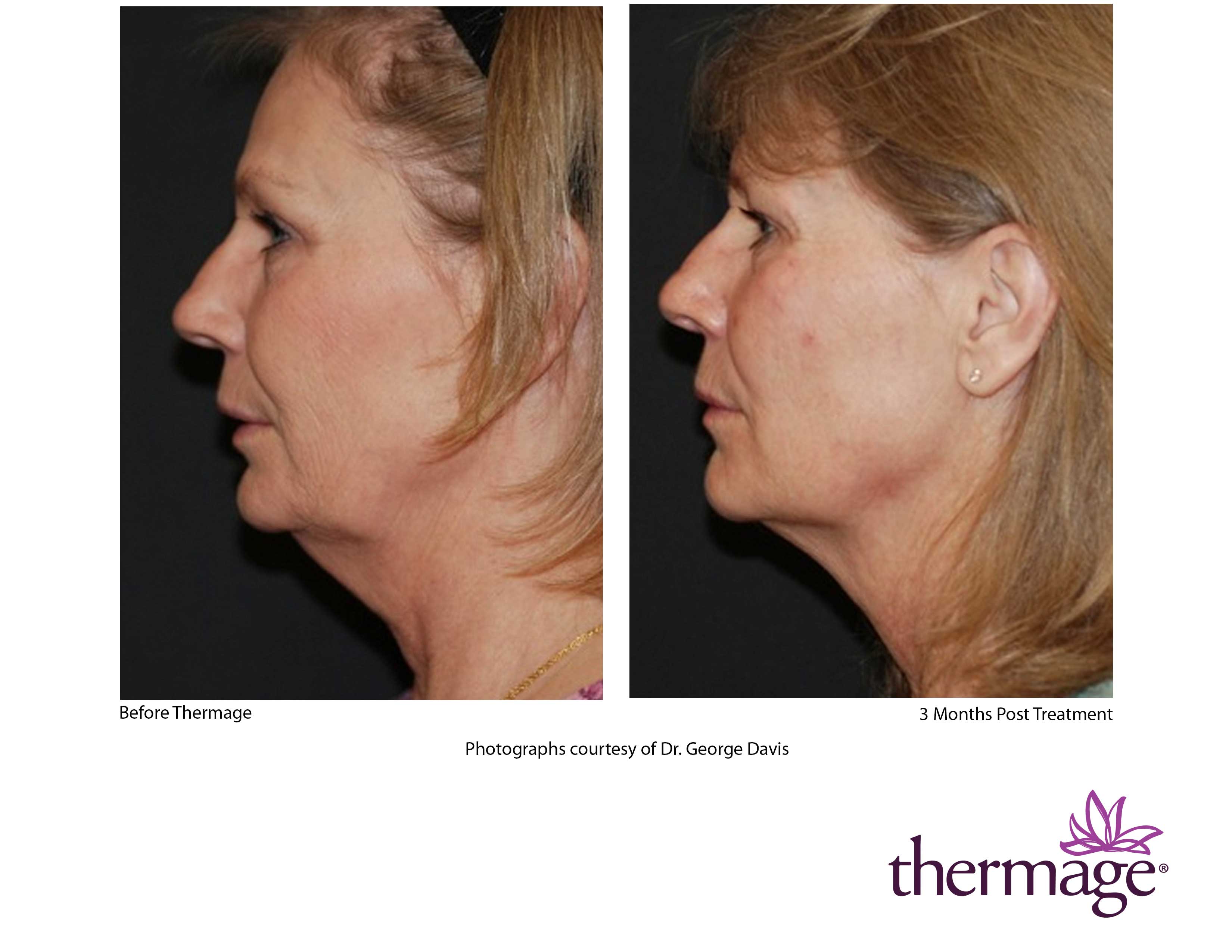 Thermage FLX full face or neck skin tightening (save €501)