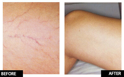 Laser thread vein removal for full legs
